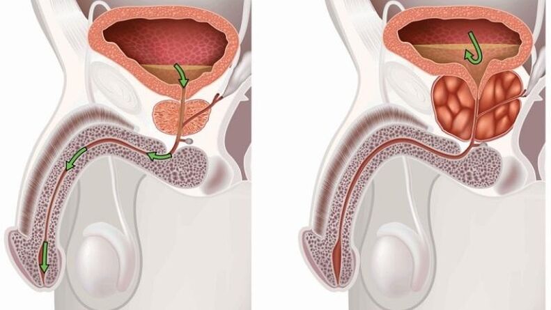 stagnarea urinei despre prostatita