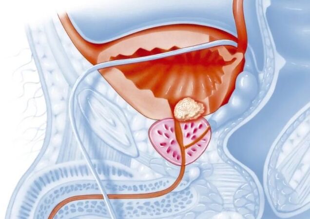 Caracteristicile prostatitei cronice